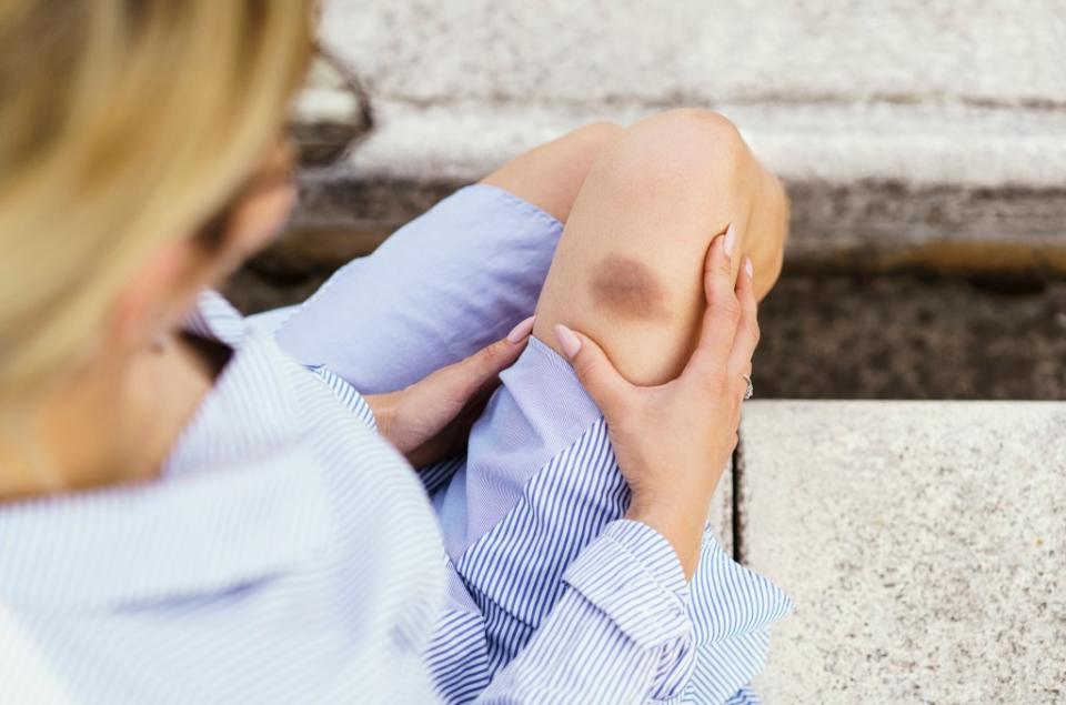 You may be bruising easily for a host of reasons, including vitamin deficiencies. Getty Images