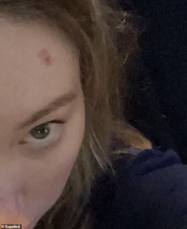 Ms Rowe's spot began quickly growing and becoming more painful after she moved to Melbourne to complete her master's degree