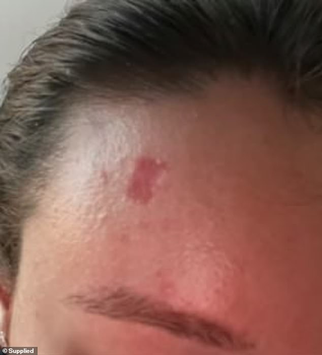 Ms Rowe visited four doctors and watched as her skin cancer grew before she finally recieved a diagnosis