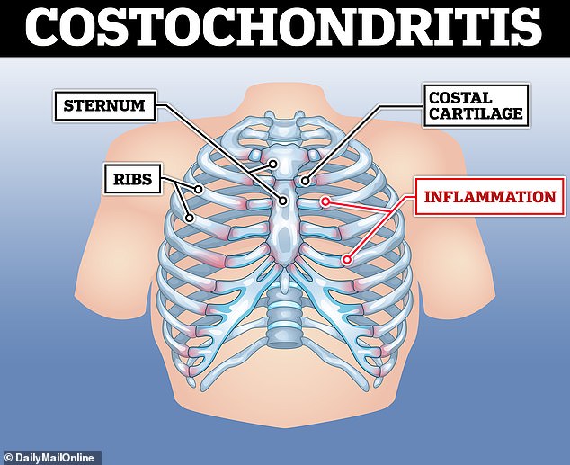 Inflamed cartilage that connects the breastbone to the ribs causes costochondritis. The inflammation causes pain that radiates from the front of the chest to the back and up into the neck