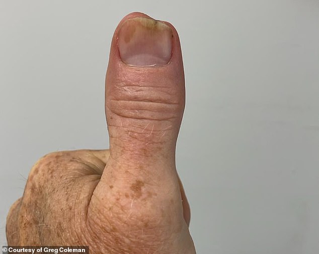 The bacterial infection got into Mr Coleman's thumb bone, so he had to have the tip removed