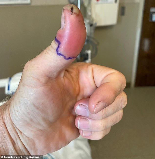 Greg Coleman, 53, was at Topsail beach in North Carolina when he sustained a small cut on his thumb which steadily worsened
