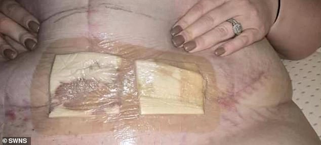 The aggressive condition, which eats away at healthy tissue, can prove fatal and left Amber needing a 'softball-sized' chunk of her stomach removed