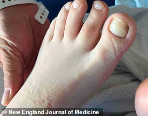 The above image shows the horizontal ridges on the 12-year-old American boy's toenails, as they had become brittle due to multiple deficiencies in vital nutrients