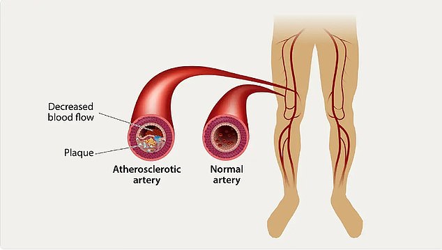 Cholesterol can build up in tiny blood vessels in the legs, causing pain when walking, numbness, hair loss, shiny skin and sores, all signs of PAD. Catching and diagnosing PAD can help someone prevent heart disease, stroke or amputation down the line, Dr Pollak said.
