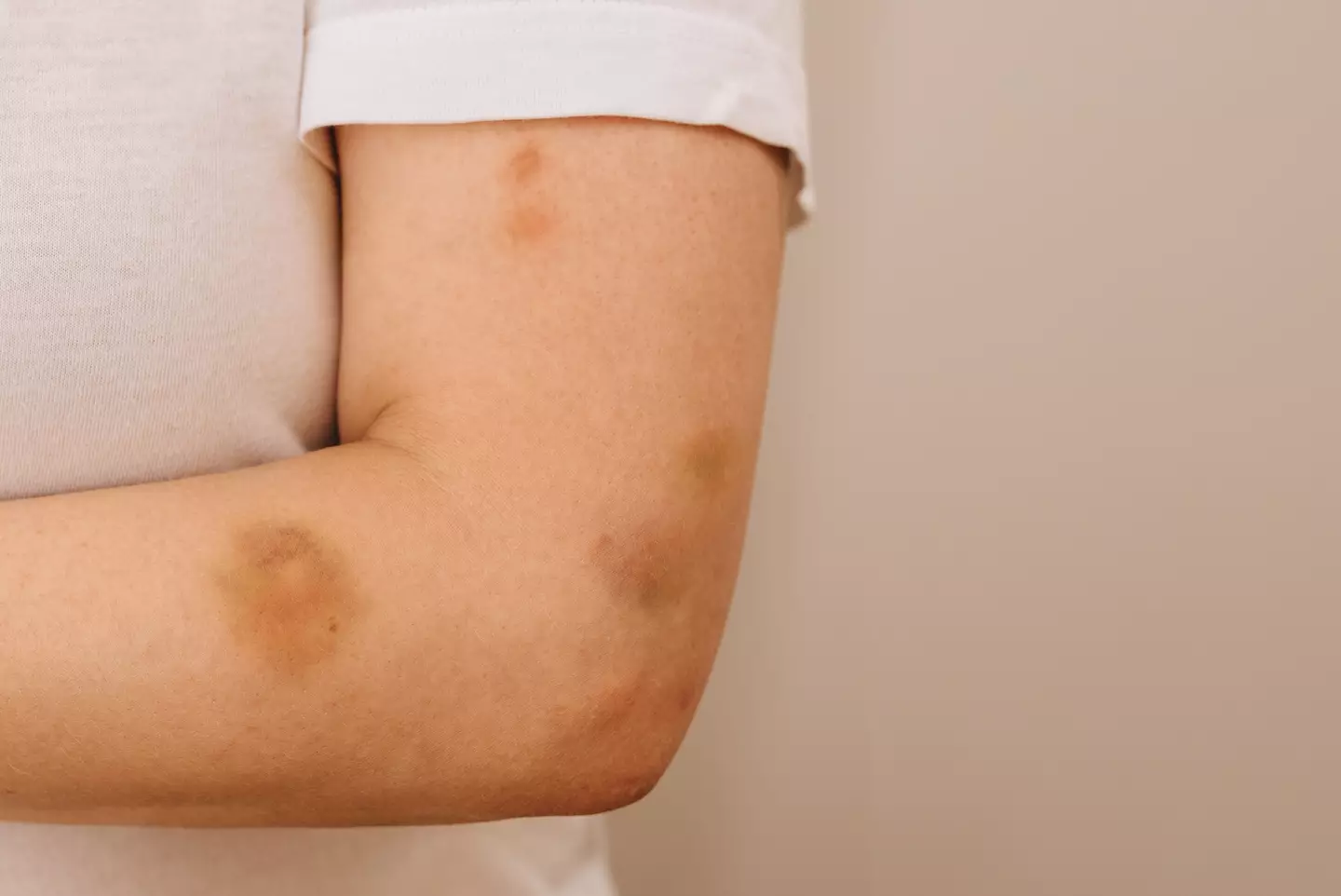 This could be a sign of a Vitamin C deficiency (Getty Stock Photo)
