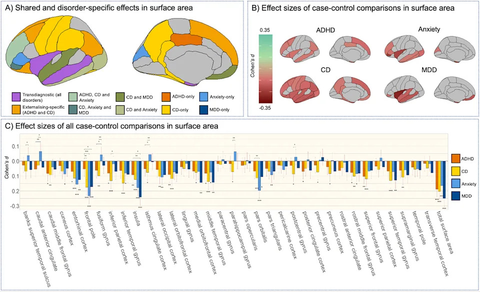 Brains with either of the four conditions tended to have a reduce surface area in regions responsible for processing emotions, responding to threats and maintaining awareness of bodily states (University of Bath)