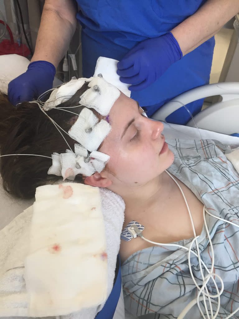 Hoffman underwent stereoelectroencephalography to pinpoint where her seizures were starting in the brain. Courtesy of Arielle Hoffman