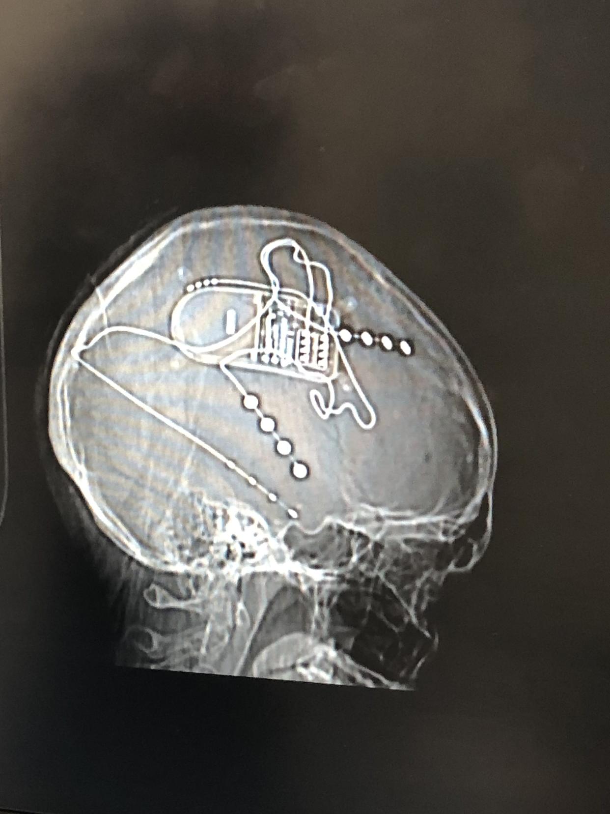 The device inside Hoffman’s brain. Courtesy of Arielle Hoffman